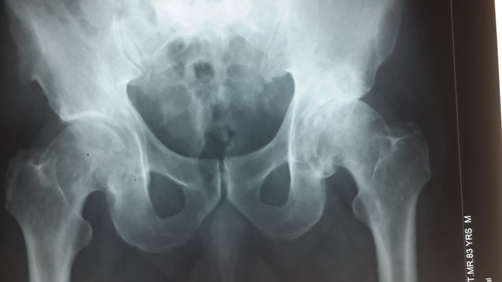 Hip osteoarthritis India Stem cell treatment Ortho