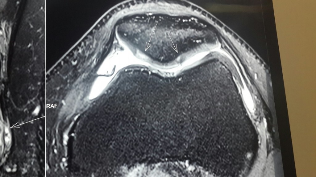 Knee Cap Cartilage Loss Treatment Ortho Biologic Surgery India