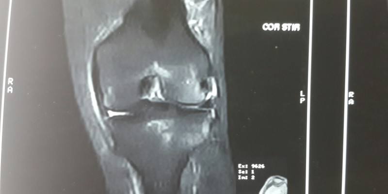 Bone marrow lesion Knee