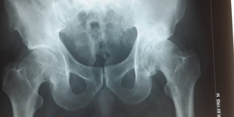 Stem cell treatment Hip Osteo-arthritis India