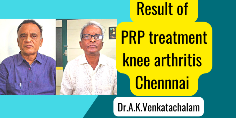 Result of PRP treatment knee arthritis Chennai India